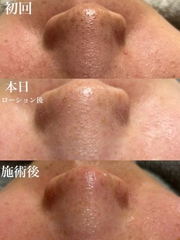 コリー(Kolly)/美容液で洗う毛穴洗浄