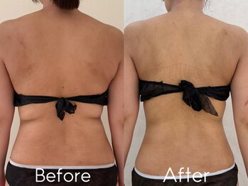 カレンジェビューティー(CarengeBeauty)/ブライダル痩身｜上半身5回