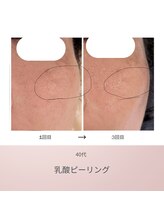 リアン(Lien)/40代　ビフォーアフター