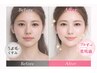 【美肌顔脱毛+シミケア】すっぴんに自信!透明感あるうるツヤ肌へ