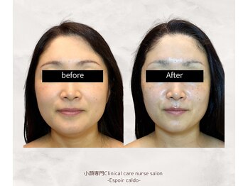 エスポワールカルド(Espoir caldo)の写真/≪30代から始める老け顔予防ケア≫リフトアップ＆お顔のバランスが整って若見え♪ 美肌育成サロン！