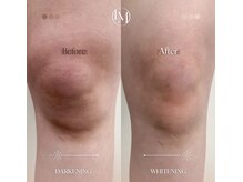 ジュエリーボディー(Jewelry body)/膝の黒ずみケアしましょう！