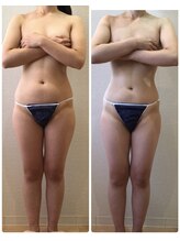 カロン(Kalon)/痩身