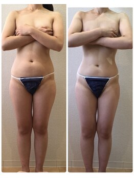 カロン(Kalon)/痩身