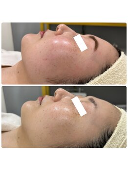 ジョアアンジェ 京橋店(joie ange)/赤み軽減