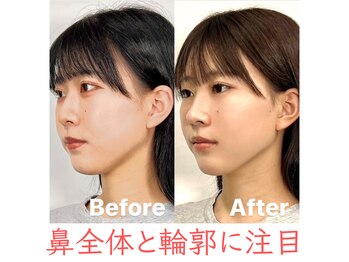ラプリ 福岡天神店(Raplit)/隆鼻+輪郭・小顔矯正 美鼻/小顔