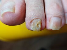 爪切り屋 足楽/爪の異常★　【before】
