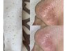 【頑固な毛穴悩みに】いちご鼻、黒ずみ毛穴、開き毛穴悩みから目指せ陶器肌