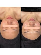 ビースキン(B SKIN)/光フォト