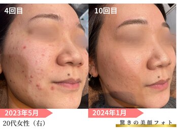 トレース/美顔フォトを1年間続けた効果