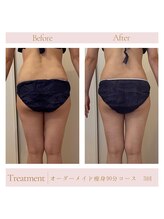 エミル(Emillu)/＊Body_ビフォーアフター