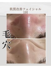 アメリオ(Amelio)/毛穴　1回