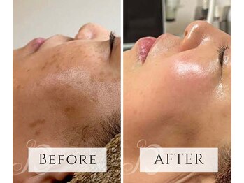 マヴィ(mavie)/気になるブツブツを改善