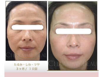 リンクアンドボーテ 大垣(Link&Beaute)/エイジングケア