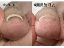 ロンディネ(Rondine)/巻き爪ケア&ネイルトリム25