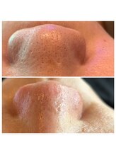 エミナル(Eminal)/◇毛穴エクストラクションtete式