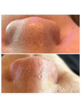 エミナル(Eminal)/◇毛穴エクストラクションtete式