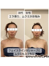 グローボックス(GLOW BOX)/ビフォーアフター