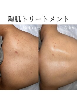 ビューティービューティー(BEAUTY BEAUTY)/陶肌トリートメント