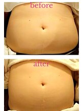 バービーホリック(barbie holic)/１６０分コース　１回の前後比較