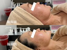 キーオブフェイス(Key of Face)/お悩み【くすみ+顔の大きさ】