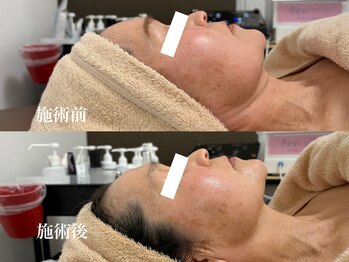 キーオブフェイス(Key of Face)/お悩み【くすみ+顔の大きさ】