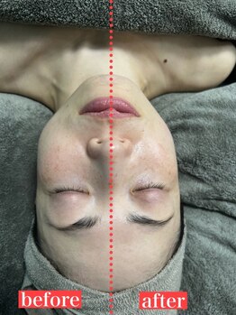 ウルオイ 海老名(URUoi)の写真/【限定価格¥12600♪】1回でこんなに！？ララピールで肌悩みリセット、小顔矯正で理想のフェイスラインへ!