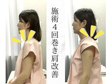 リバティ 世田谷代田整体院(Liberty)/短期集中改善コースで巻き肩改善