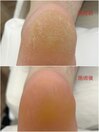 本格角質ケア