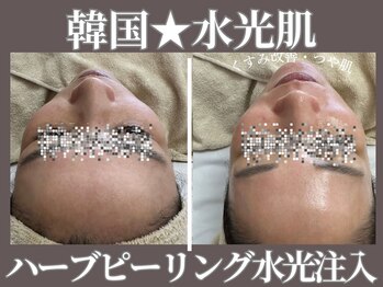 マヴィ 守口店(MavY.)/ハーブピーリング×水光注入