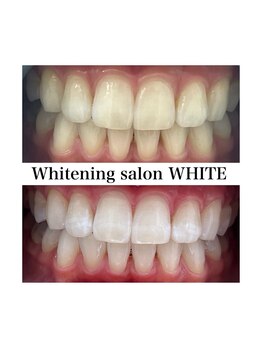 ホワイトニングサロン ホワイト 前橋店(WHITE)/8回でここまでトーンアップ！