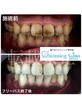 ホワイトニングサロン 福岡天神店/ホワイトニング