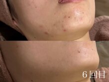 アワピール 天王寺店(AWA PEELL)/ハーブピーリング/ニキビケア