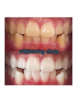 ホワイトニングショップ 所沢店/ホワイトニングショップ所沢店