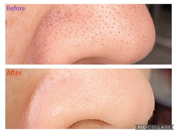 グレイティフル(Grateful)/小鼻もスッキリ