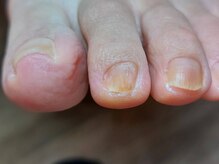 爪切り屋 足楽/爪の異常★　【after】