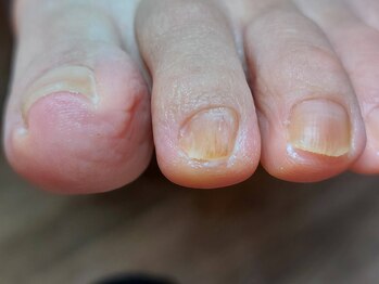 爪切り屋 足楽/爪の異常★　【after】