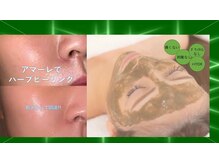 ビューティークリニーク アマーレ(Amare)/ハーブピーリング毛穴ケア