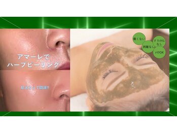 ビューティークリニーク アマーレ(Amare)/ハーブピーリング毛穴ケア