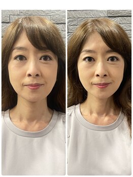 長寿鍼灸院 長寿整骨院/美容鍼50本の効果★ハリ・ツヤ