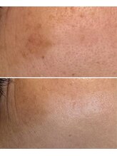 じぶんniプラス/常滑/フェイシャル/シミ/たるみ