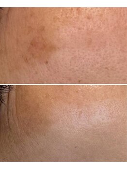 じぶんniプラス/常滑/フェイシャル/シミ/たるみ