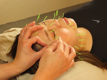 南保/施術風景/美容鍼