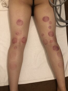 中国整体 らくらく堂/腰脚リンパケア吸い玉デトックス