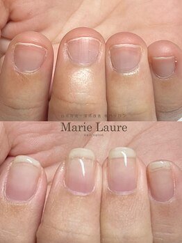 マリーロール 梅田店(Marie Laure)/自爪育成/深爪矯正/ネイルケア