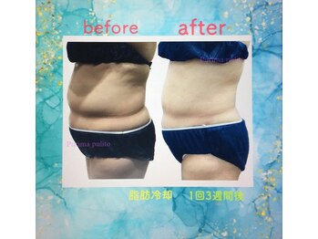 プリマプリート 各務原店/脂肪冷却の1回の効果！