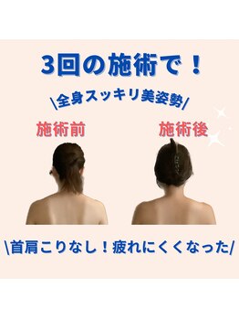 ミトラ(MITRA)/たった3回！コリも痛みも解消！