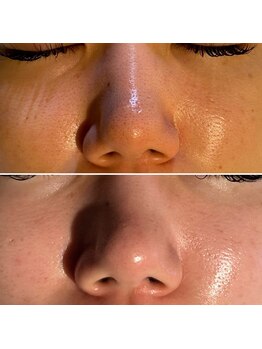 レアリゼ(Realiser)/クリスティーナで肌質改善