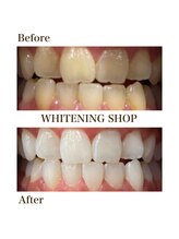 ホワイトニングショップ つくば店(WHITENING SHOP)/ホワイトニングビフォーアフター
