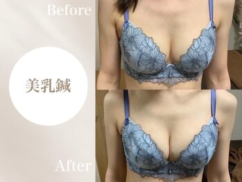 Onはり灸サロン/バストUP美乳鍼before→after